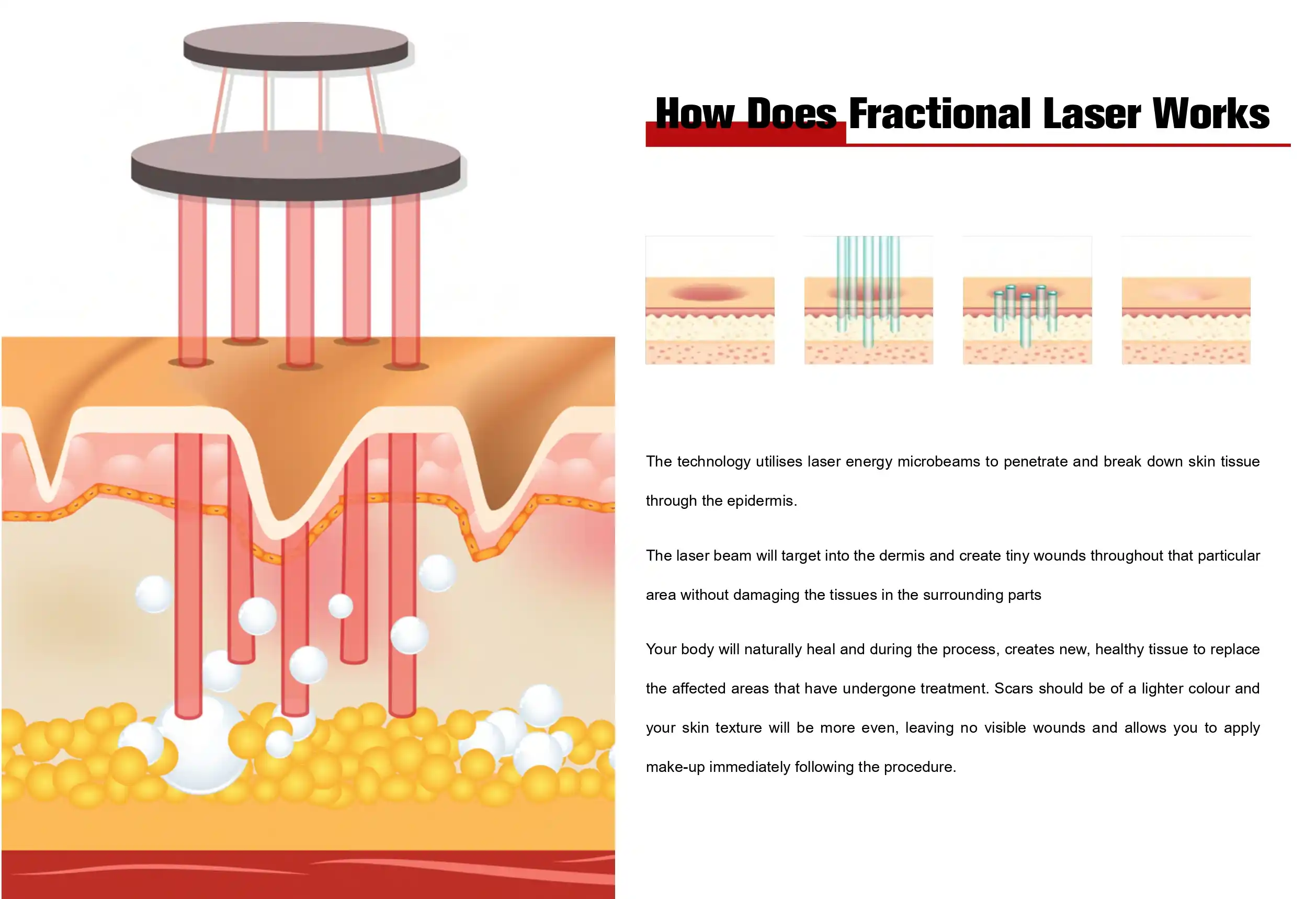 CO2 Fractional Laser Machine Manufacturers